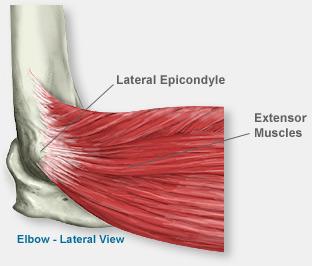 title Lateral Epicondylitis